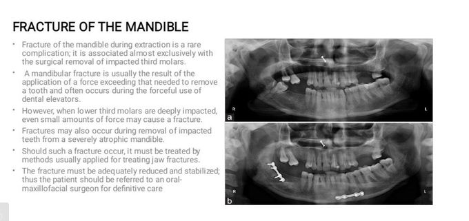 Fracture of Mandible