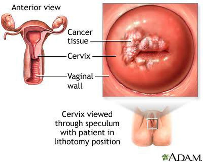 Treatment of vaginal cancer