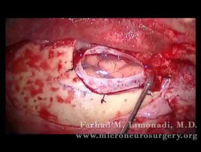 Resection of Metastatic Lung Cancer (brain surgery)
