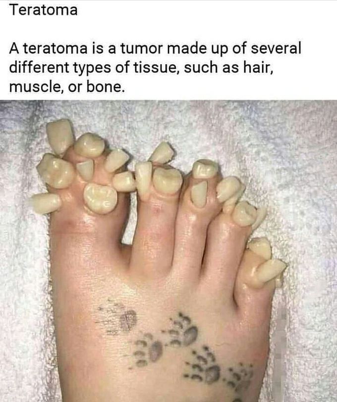 Teratoma