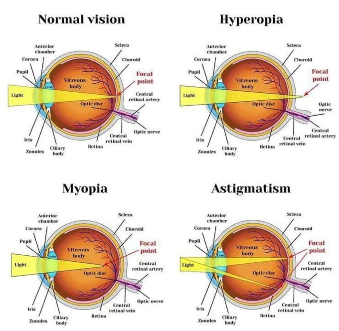 Refractive Errors