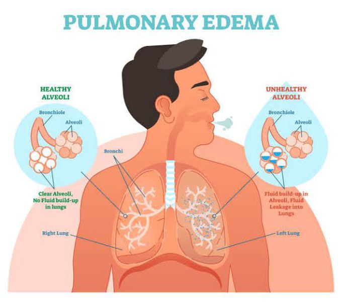 Pulmonary edema treatment