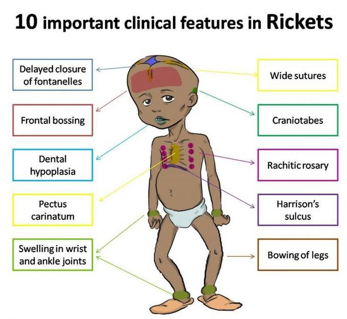 Rickets