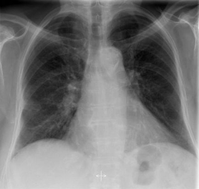 Chest xray..