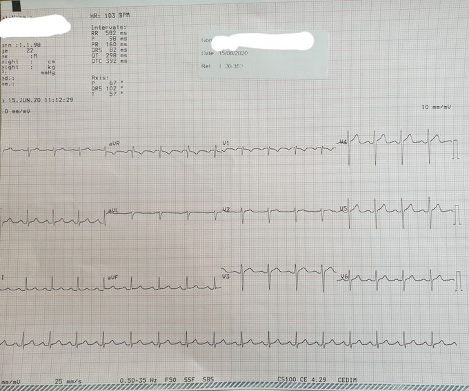 ECG interpretation?
