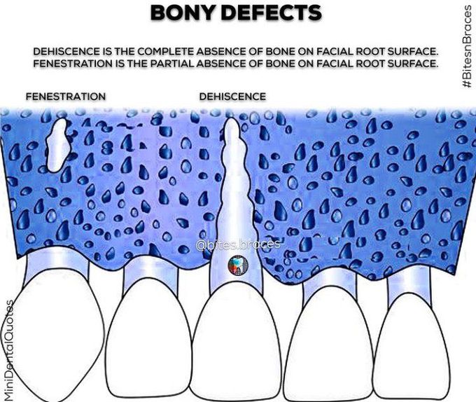 Bony Defects