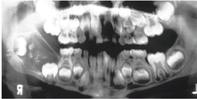 Ameloblastic Fibro-Odontoma