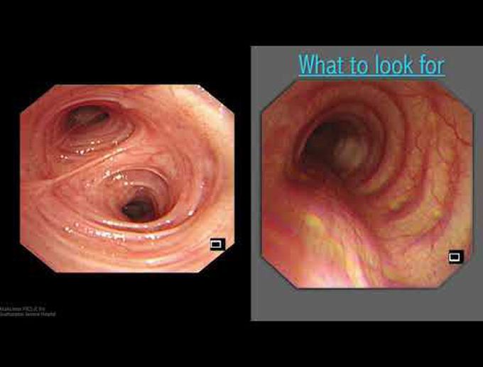Mastering Bronchoscopy for Thoracic Surgery: Chapter 5