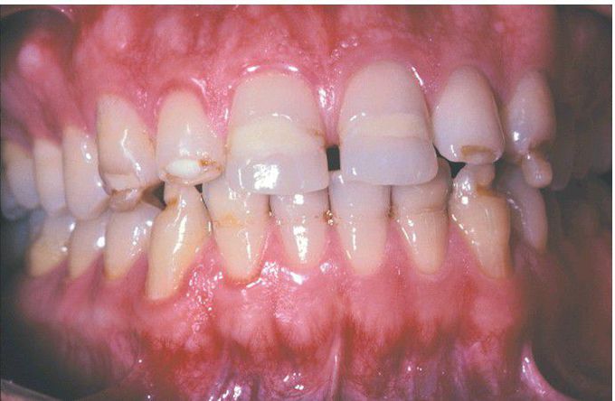 Environmental enamel hypoplasia