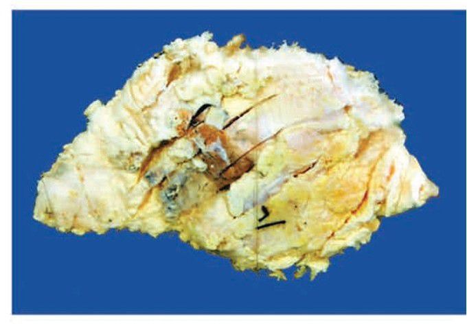 Infiltrating duct carcinoma-NOS.