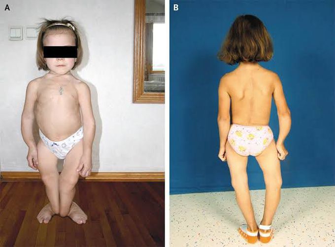 What is Rickets?