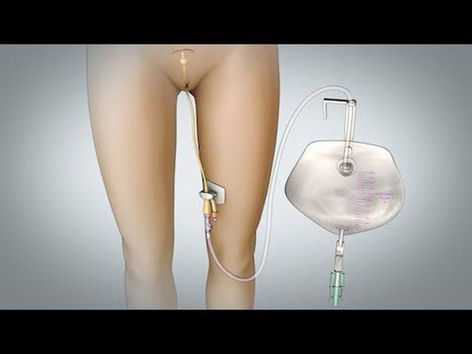 Removal of Foley Catheter (Female)