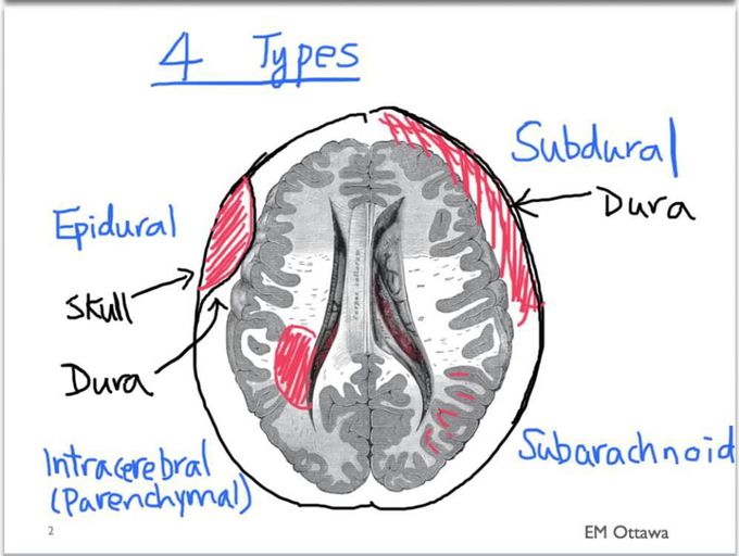Intracranial hemorrhage types