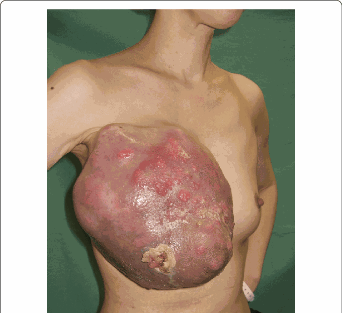 Phyllodes Tumor