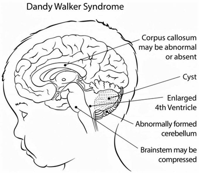 Dandy Walker malformation