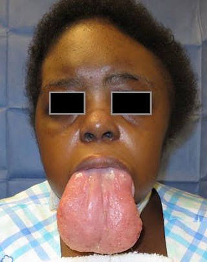 Treatment of macroglossia