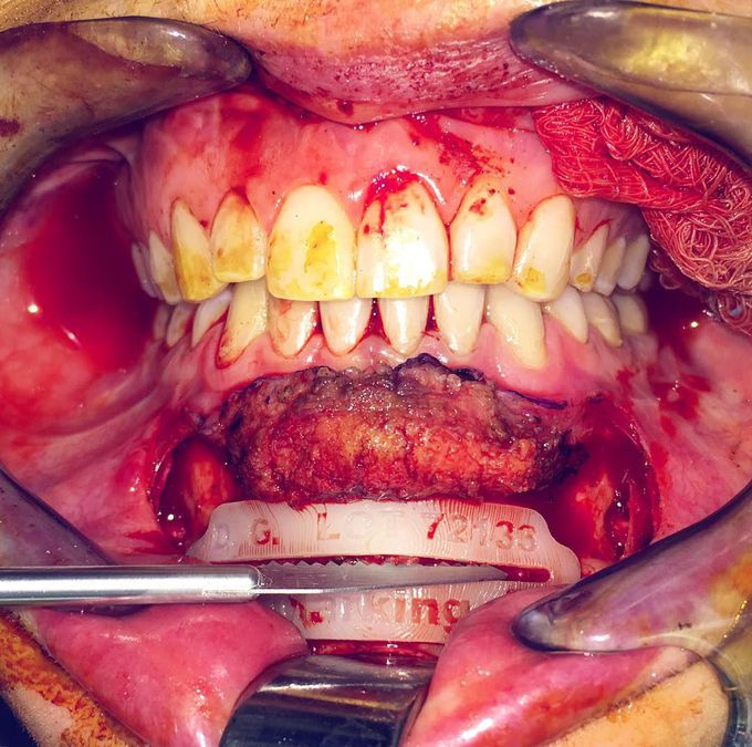 Advancement genioplasty to augment the chin 💀 