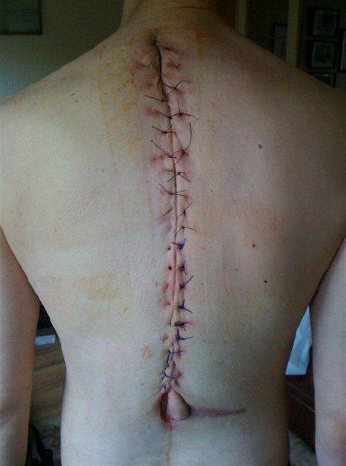 Post spinal surgery incision