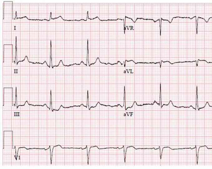 Axis  deviation