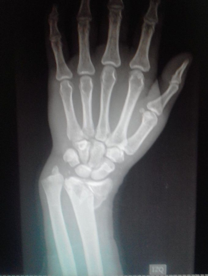 Whats type of fracture is it?