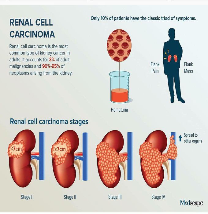 Renal cell carcinoma