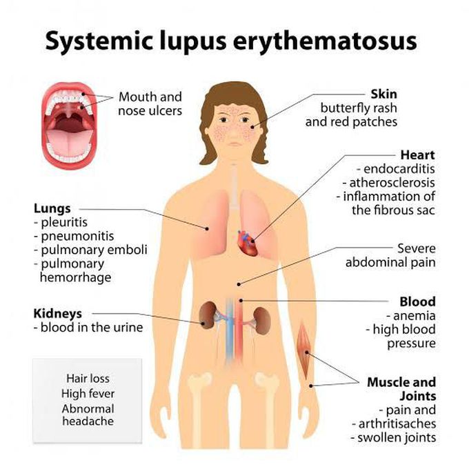 Systemic lupus erythematoses