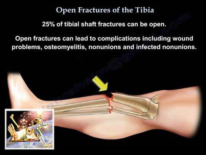 Tibia-Open fractures