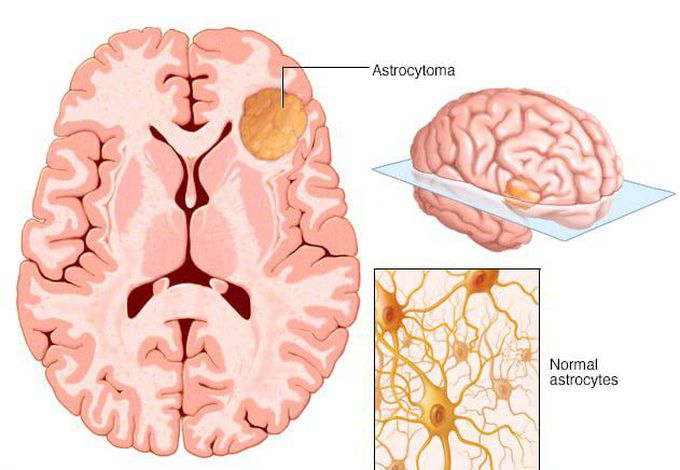 Astrocytoma