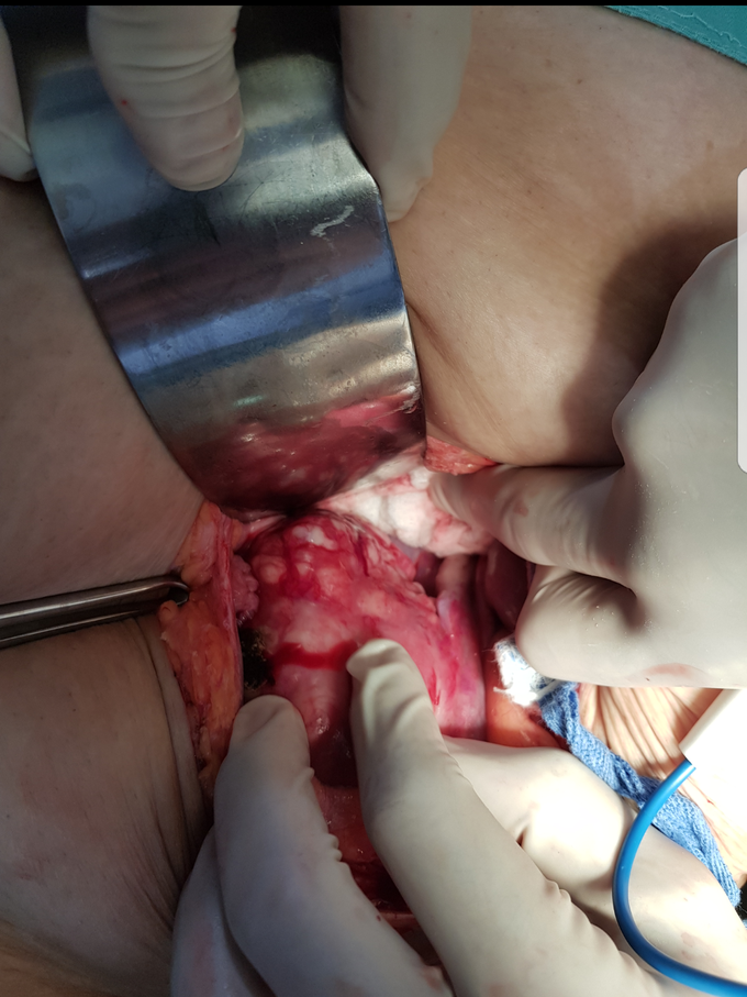 Advance uterus cancer