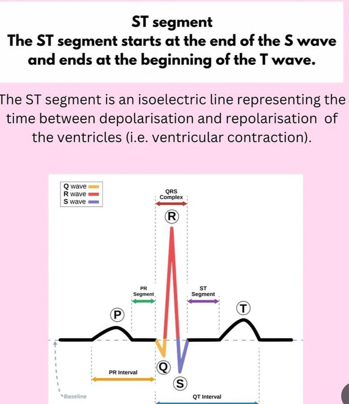 ST Segment