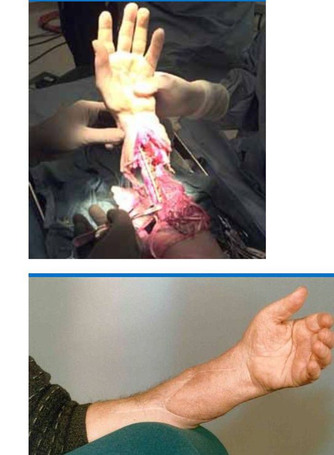 Reconstructive microsurgery