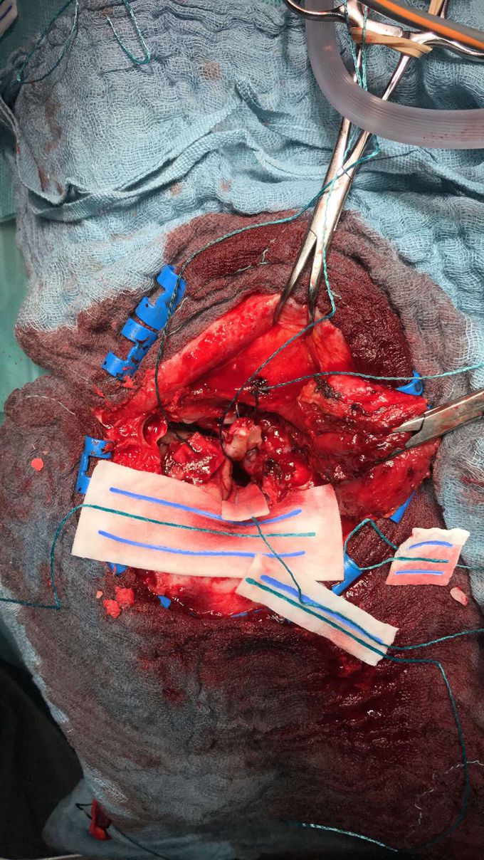 Brain surgery