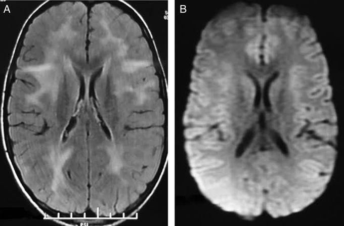 Subacute sclerosing Pan encephalitis (SSPE)