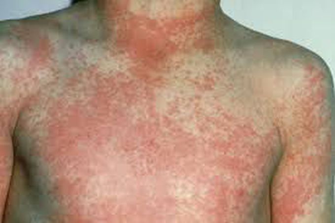 Scarlet fever cause