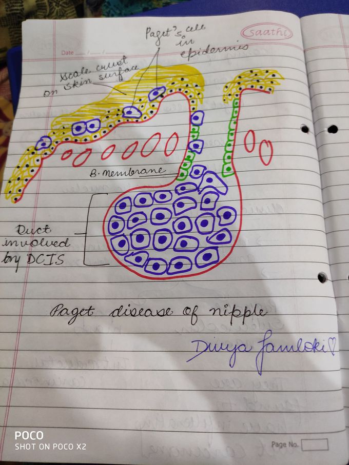 Paget's disease of nipple🖤
