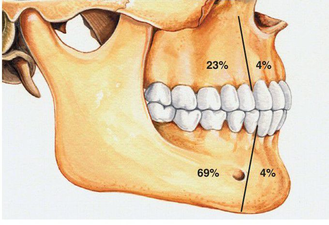 Ameloblastic Fibroma distribution