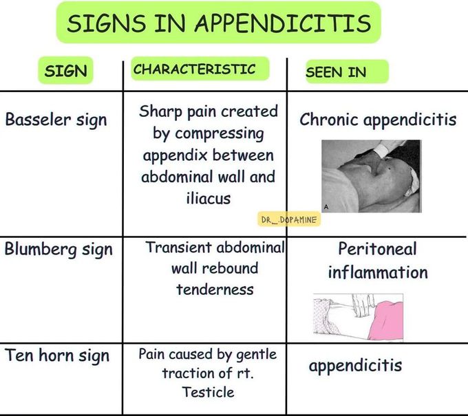 Signs in Appendicitis III
