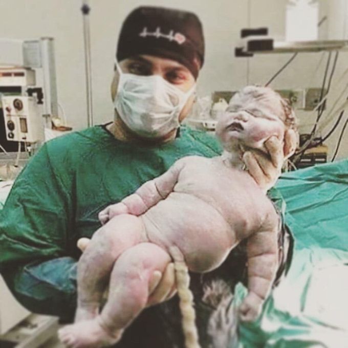 Giant baby ever born ! ( 7.5 kgs)😯😳