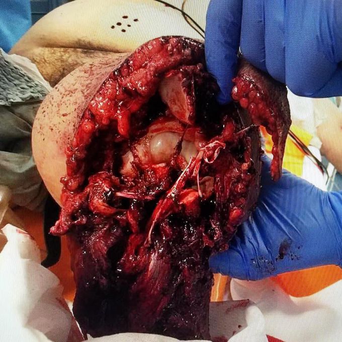 Traumatic amputation!