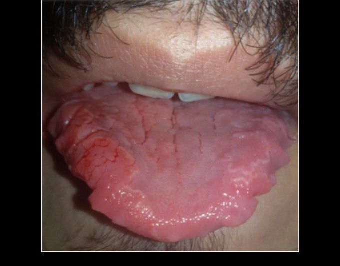 Migratory glossitis