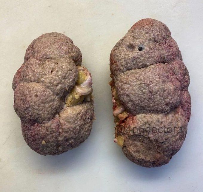 Kidneys from the autopsy of an embalmed body