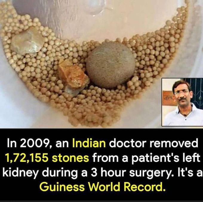 172155 stones in a single kidney