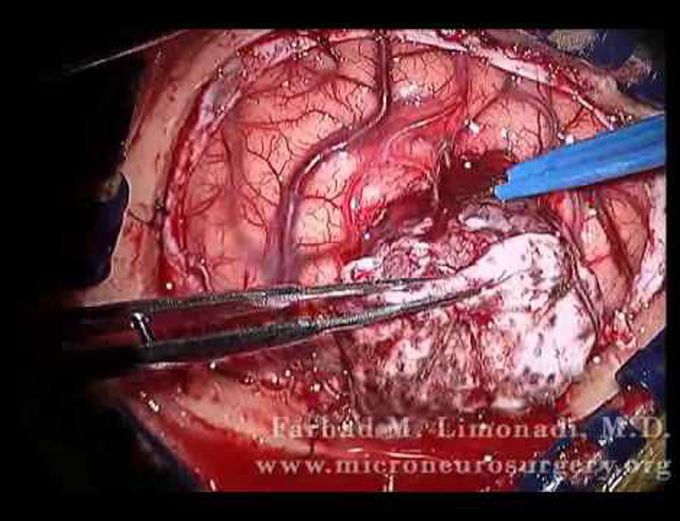 Occipital Meningioma surgical removed with Craniotomy