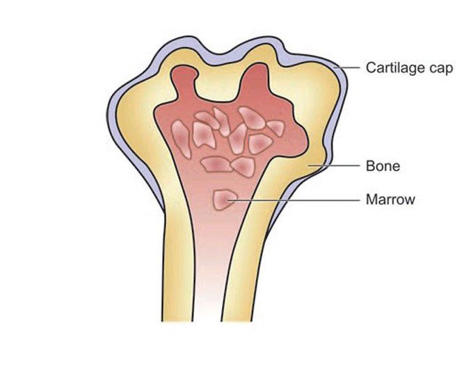 Osteochondroma