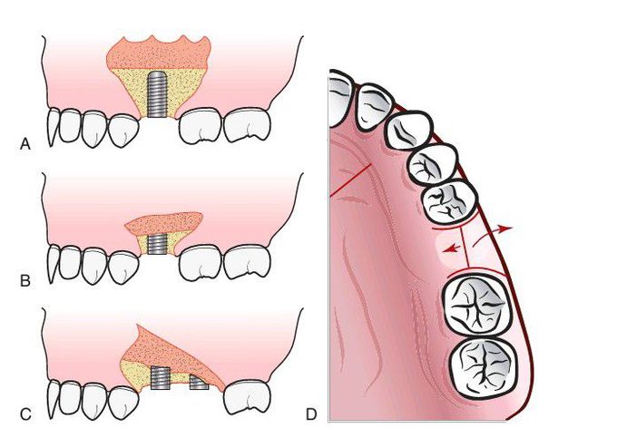 Incisions for implant