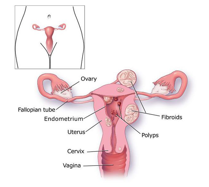 Complications of menorrhagia