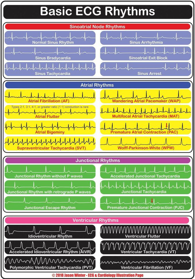 ECG Rhythms