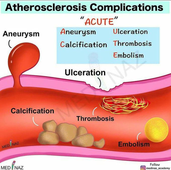 Atherosclorosis