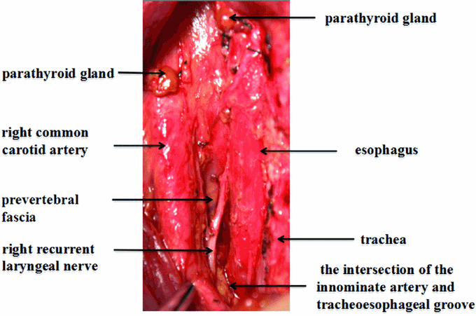Right cervical central VI-2 after complete lymph node dissection
