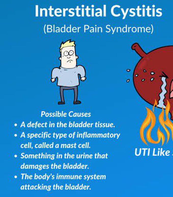 These are the causes of Interstitial Cystitis syndrome